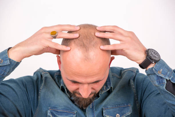 Stress-Induced Hair Loss: What it Means, Causes and Risk Factors, Signs and Symptoms
